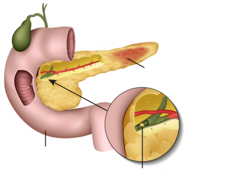 pancreatite é uma inflamação do pâncreas